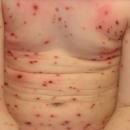 Pic de varicelle dans la région Hauts-de-France