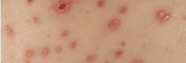 La région encore touchée par un pic de varicelle