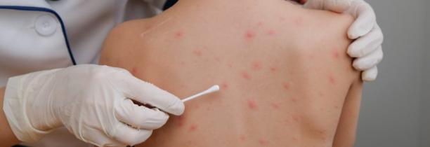 Le retour de la varicelle dans la région